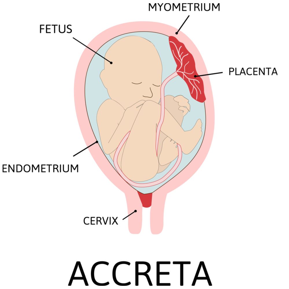 placenta-accreta-wenn-sich-die-plazenta-l-st-moms-de